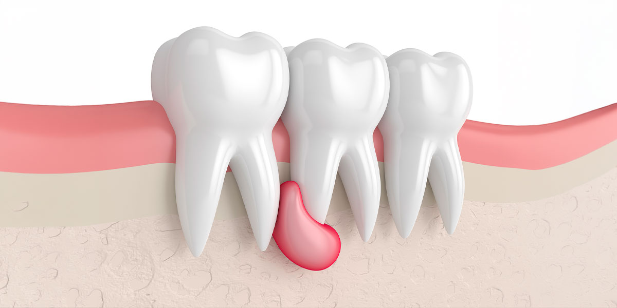 Résection apicale (apicectomie)