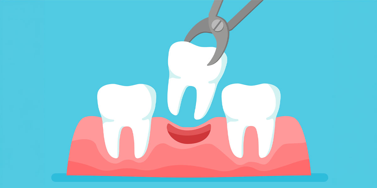 Extraction dentaire simple