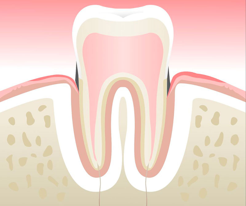 Gingivite : stade 1, inflammation de la gencive